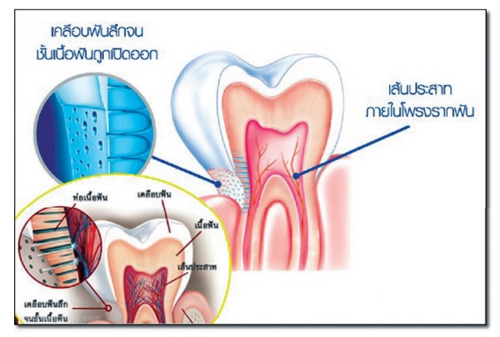 เสียวฟัน