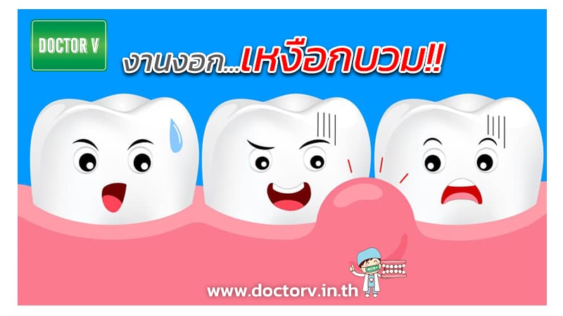 อาการเหงือกบวม อักเสบ ยาสีฟันสมุนไพร ช่วยได้ ป้องกันดีกว่ารักษา