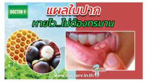 แผลในปาก