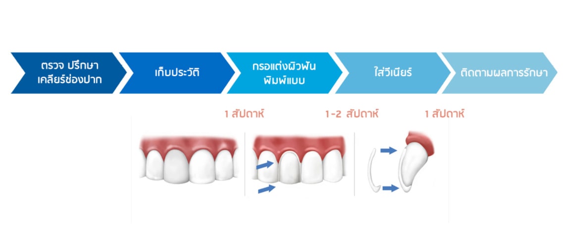 วีเนียร์