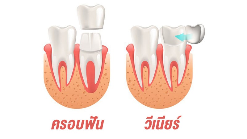 วีเนียร์