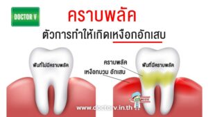 คราบพลัค