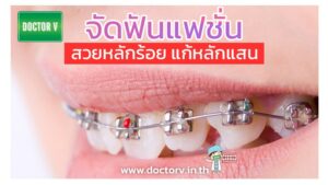 จัดฟันแฟชั่น