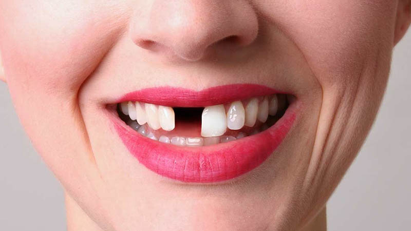 ฟันแท้ ถูกถอนไป จะเกิดปัญหาอะไรบ้าง ?