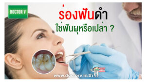 ร่องฟันดำ