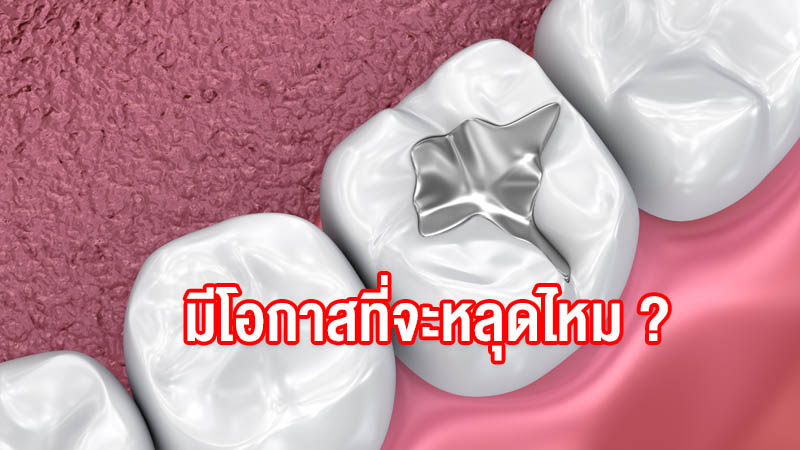 อุดฟัน