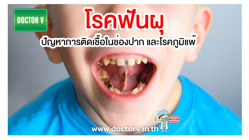 โรคฟันผุ