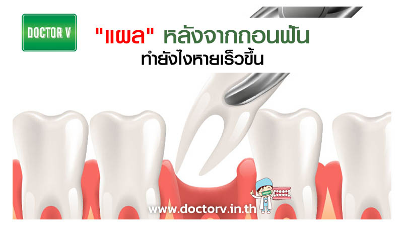 แผล