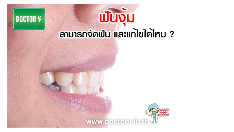 ฟันงุ้ม สามารถจัดฟัน และแก้ไขได้ไหม ?