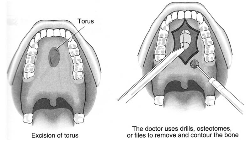 Torus palatinus