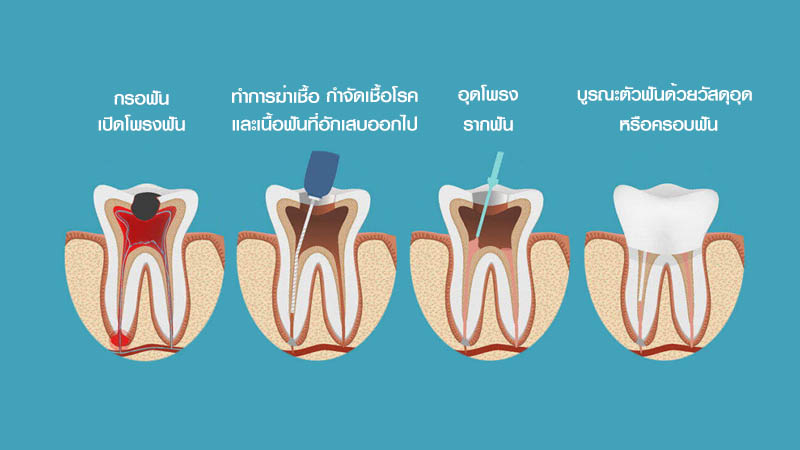 รักษารากฟัน
