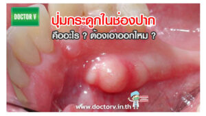 ปุ่มกระดูกในช่องปาก