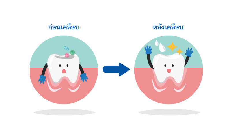 เคลือบหลุมร่องฟัน