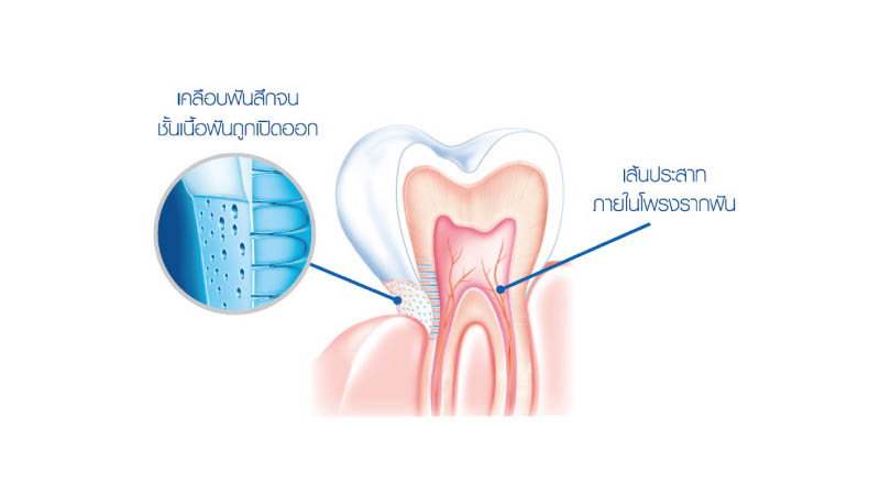 เคลือบฟันสึก