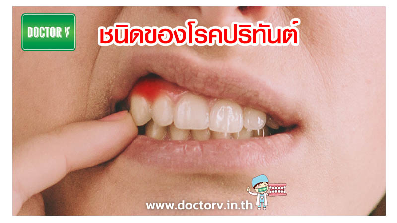 ชนิดของโรคปริทันต์