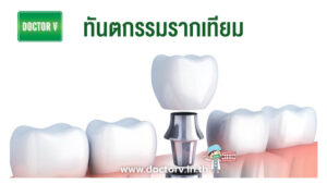 ทันตกรรมรากเทียม